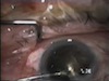  Capsular Blowout During Hydrodissection 