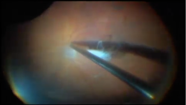 Iatrogenic Macular Tear