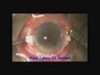 Scleral Fixation of IOL Using Fibrin Glue