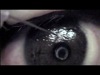 Post-LASIK Anterior Stromal Puncture Technique