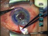 DSEK No-fold Needle Insertion Technique
