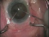  Divide and Conquer Cross-Chop: A Simple, Easy, and Effective Approach for Nucleus Disassembly
