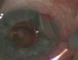 (Nearly) Sutureless Placement of a Secondary Sutured PCIOL with 25G PPV