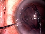Flipping over a Akreos lens in the Eye