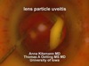 Lens-Particle Uveitis