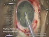 Ultrasound-free Laser Cataract Surgery