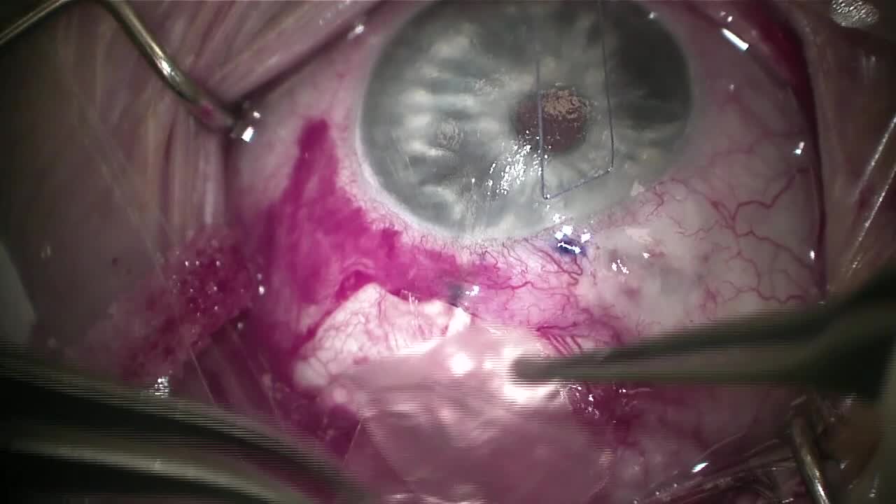 Molteno 3 Glaucoma Drainage Device