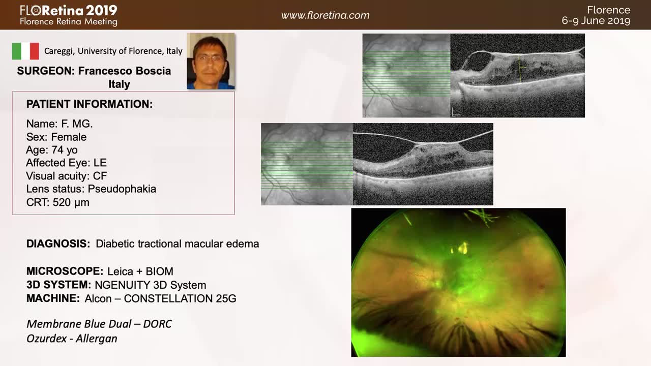 [3D] Staining Techniques and Prevention of PVR Postoperatively in an Eye With Diabetic Tractional Macular Edema