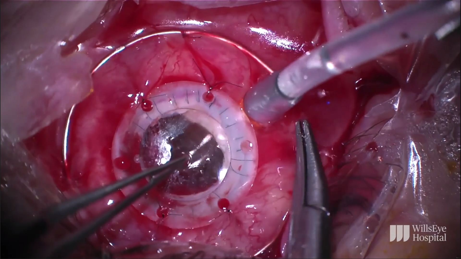 A Team Approach to Managing Complications After Corneal Transplantation