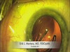 Implantation of the Lentis M-plus IOL