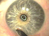 Laser PRK for Herpetic Corneal Scar to 20/20 vision