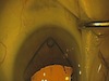 Novel Instruments for Positioning Malyugin Ring