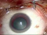 25-gauge Macular Hole Surgery