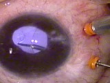 23G MIVS to Re-suture a Transsceral IOL