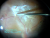 Traction Retinal Detachment