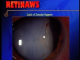 Endoscopic SPCIOLs - Part 1