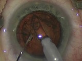 Routine Phaco