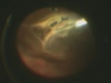 Airbag Induced Retinal Detachment
