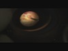 Transconjunctival Sutureless 23-gauge Vitrectomy for Diabetic Retinopathy