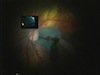 Subretinal ICG During Macular Hole Surgery