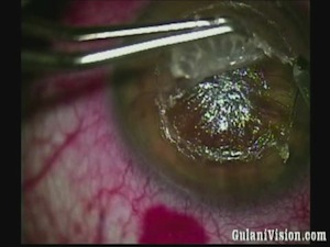 Corneal Scar with 18-incision RK, Ectasia
