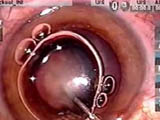 Using the Mackool Cataract Support System (CSS)