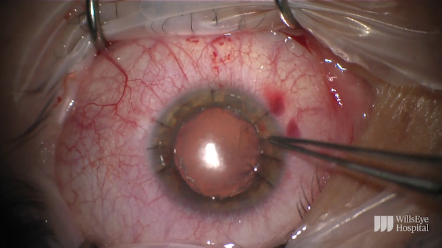 Managing Striae Weeks After LASIK
