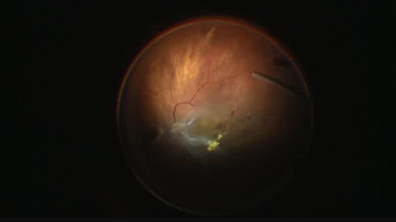 Diabetic Retinopathy Surgery [FLOREtina Live Surgery]