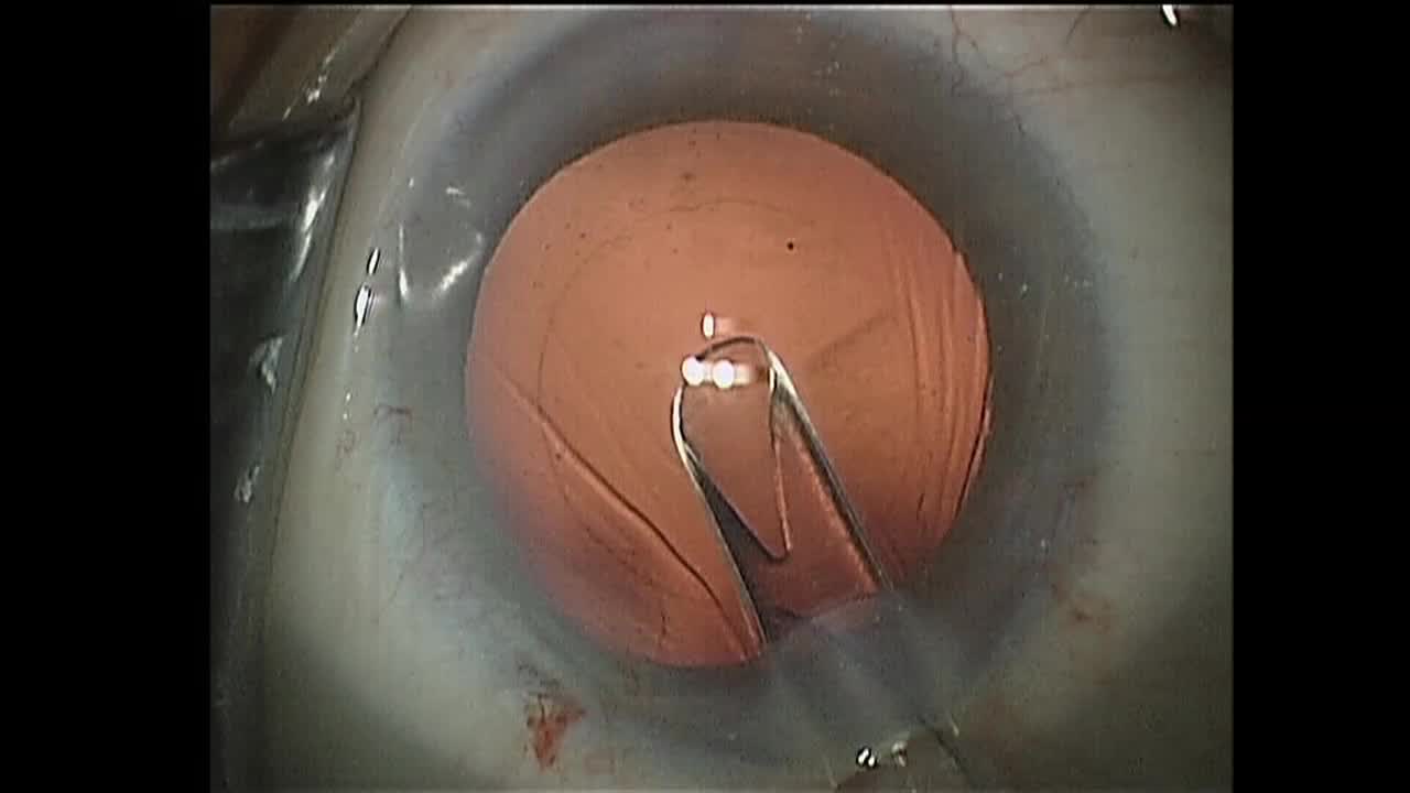Posterior Capsulorhexis