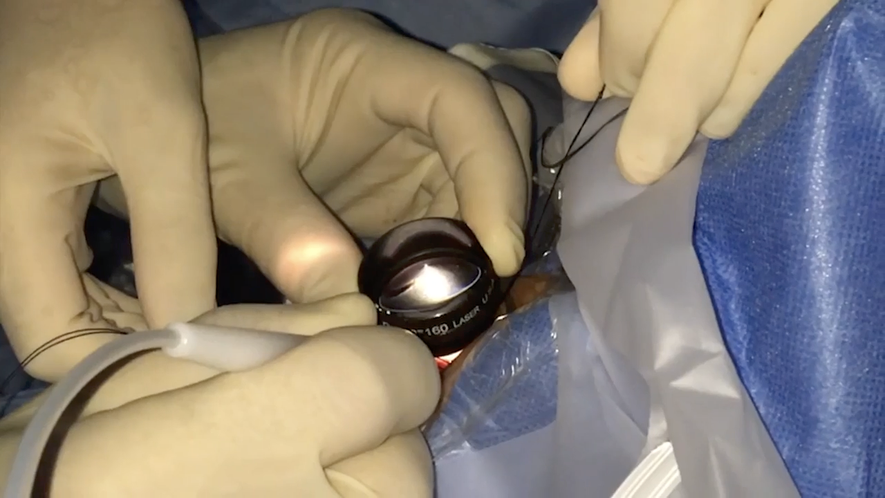 Slit Light Surgery