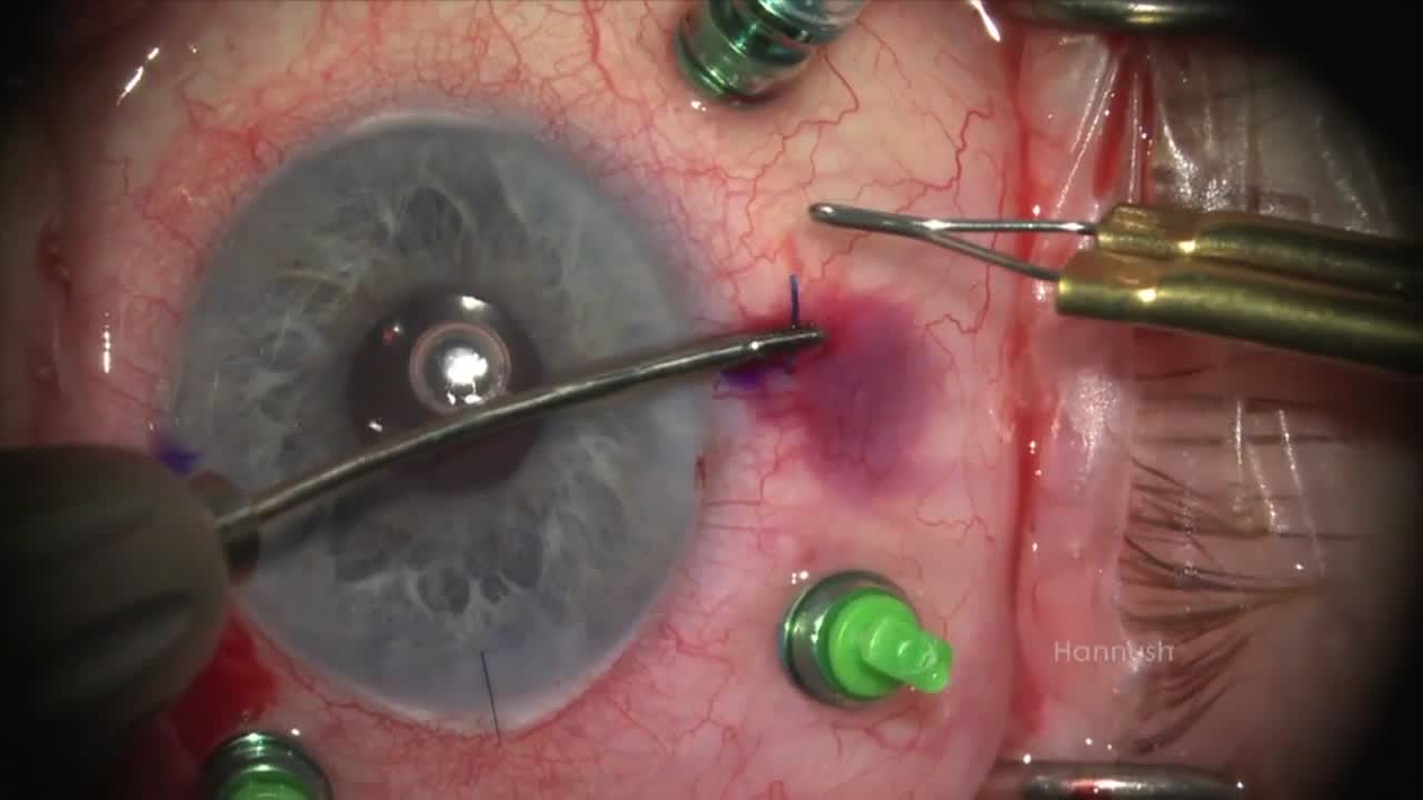 Dislocated IOL-Capsular Bag Complex: Retrieval and Replacement