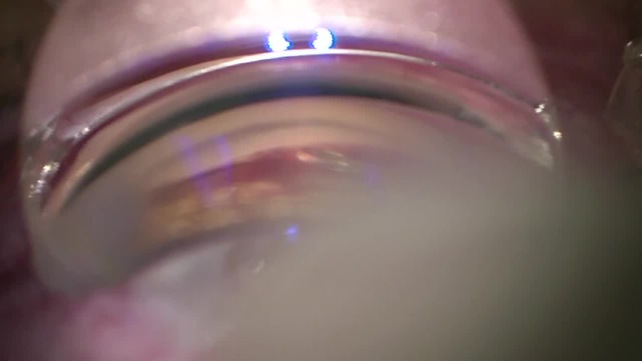 Viscodilation and Hydrus Implantation