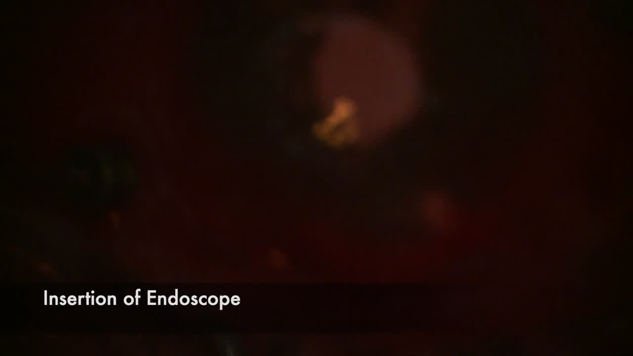 Pars Plana Tube With Endoscopic PPV