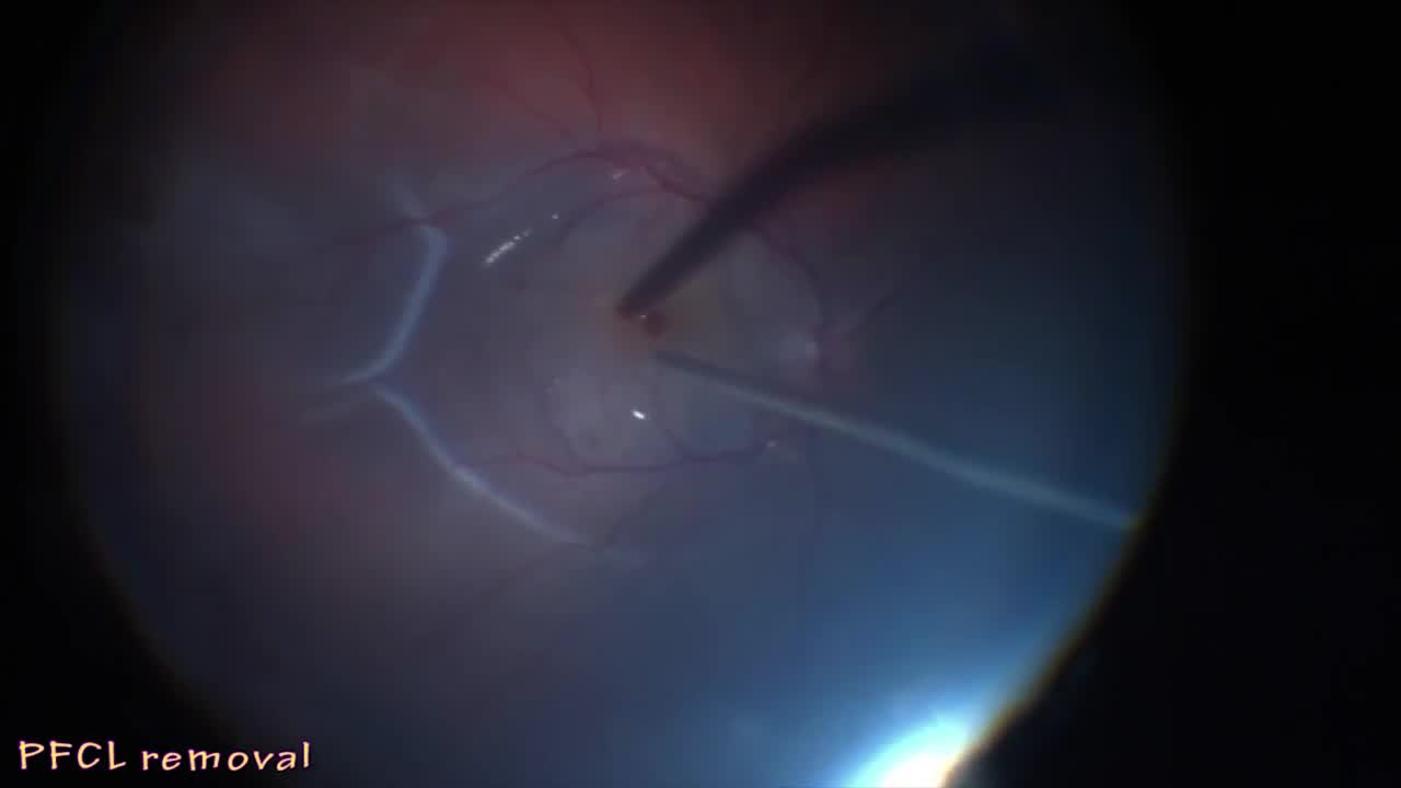 Retinal Autograft in Long Standing Detachment with Large Macular Hole
