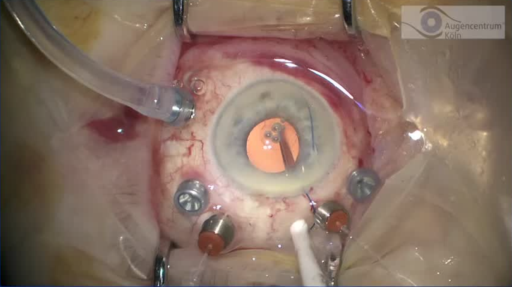 Subluxated IOL & RD