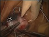 Management of Pediatric Traumatic Glaucoma After a Scleral Buckle 