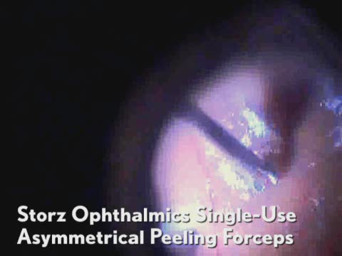 Single-Use Asymmetrical Peeling Forceps