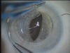 Iris Fixation