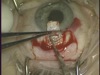 Canaloplasty