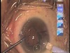 Zeiss Multifocal Toric IOL Implantation