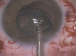 Intrascleral Posterior Chamber Lens Implant Fixation Combined With 23-gauge Plana Plana Vitrectomy: Temporary Haptic-fixation with Silicone Plug
