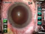 Creating a Square Incision