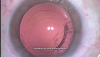 Preventing Extension of a Posterior Capsular Tear