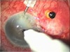 Temporary Keratoprothesis in Ocular Trauma