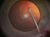 Clear Lensectomy: Myopia