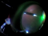 Peripheral Vitreous Shaving Endolaser in Phakic Patients