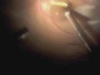 PVR and Forceps