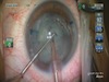 Catalys LRCS With ReSTOR IOL