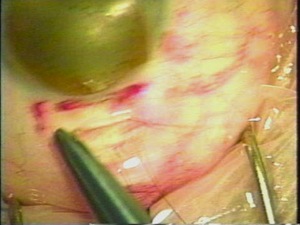 Horizontal Anchor Sutures