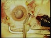 Partial PPV During IOFB Removal